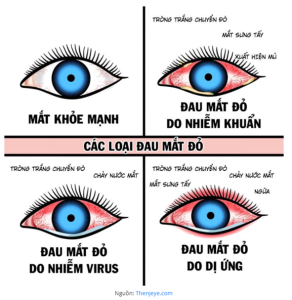 Bệnh đau mắt đỏ, dấu hiệu nhận biết và các biện pháp phòng tránh